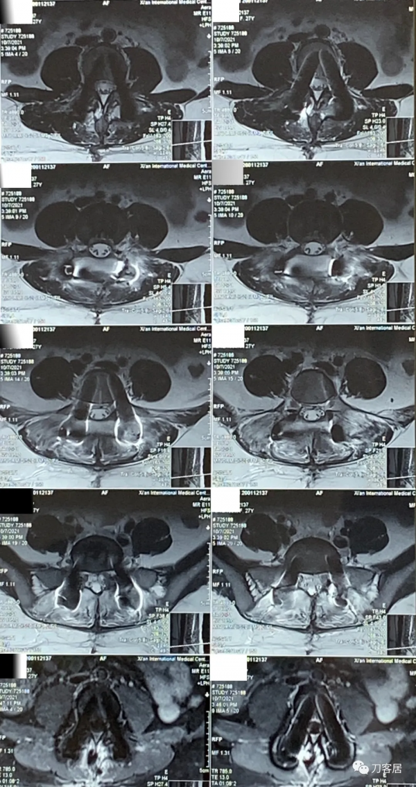27歲女性，兩間隙腰椎間盤突出症，6顆釘子，4個融合器