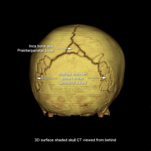 頭皮和顱骨病變的影像學特點 頭皮和顱骨病變的影像學特點