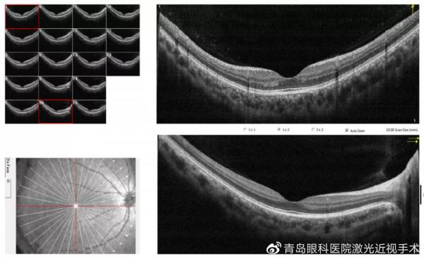 ICL晶體植入術前和術後要做哪些檢查？一次說明白