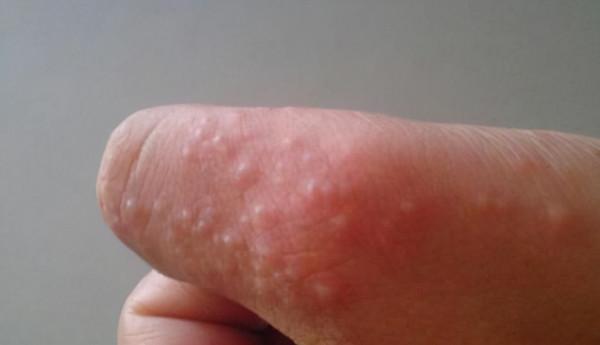 手腳面板佈滿“小水泡”,異常瘙癢,這一方面,可能出了問題 手腳面板佈滿“小水泡”,異常瘙癢,這一方面,可能出了問題