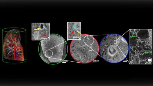 他們用人類史上最強的X光，告訴我們新冠患者的肺傷成了什麼樣