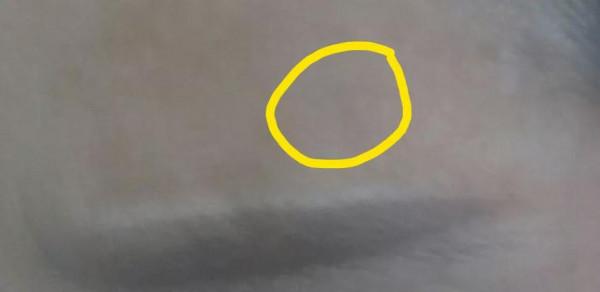 &quot;藥水點斑&quot;究竟好不好？點斑一年以後的我用真實的效果來告訴你