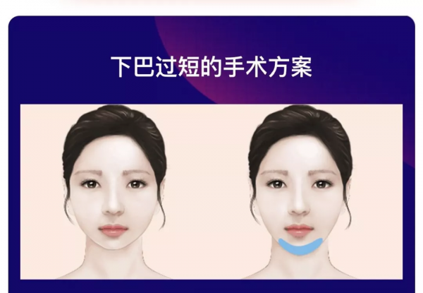 改善突嘴問題，是否需要進行正頜