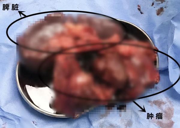 兇險!六旬大爺頭暈入院,不料肚子裡竟藏著一顆15cm的“定時炸彈” 兇險!六旬大爺頭暈入院,不料肚子裡竟藏著一顆15cm的“定時炸彈”