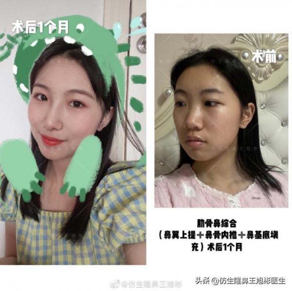 鼻頭縮小可以只“減脂”，不取自體軟骨做支架嗎？