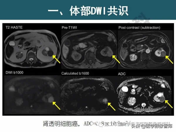 體部DWI共識及胰腺DWI研究經驗介紹