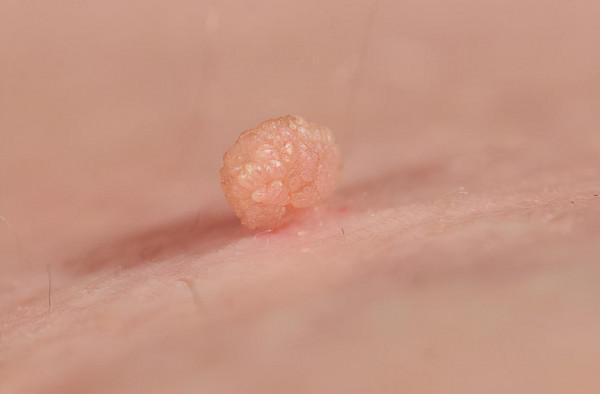 面板上的小肉球、小肉疙瘩是什麼？7種可能，情況有好有壞