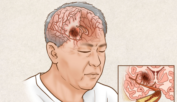 大面積核心梗死卒中患者，仍可從血栓切除術中獲益