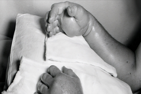 DNA斷裂,肌肉溶解,徒手掰開原子彈的他,成了等待死亡的活死人 DNA斷裂,肌肉溶解,徒手掰開原子彈的他,成了等待死亡的活死人