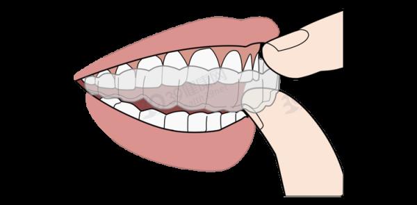 為什麼只要戴牙套,牙齒就可以恢復得很整齊?生動展示矯正過程 為什麼只要戴牙套,牙齒就可以恢復得很整齊?生動展示矯正過程