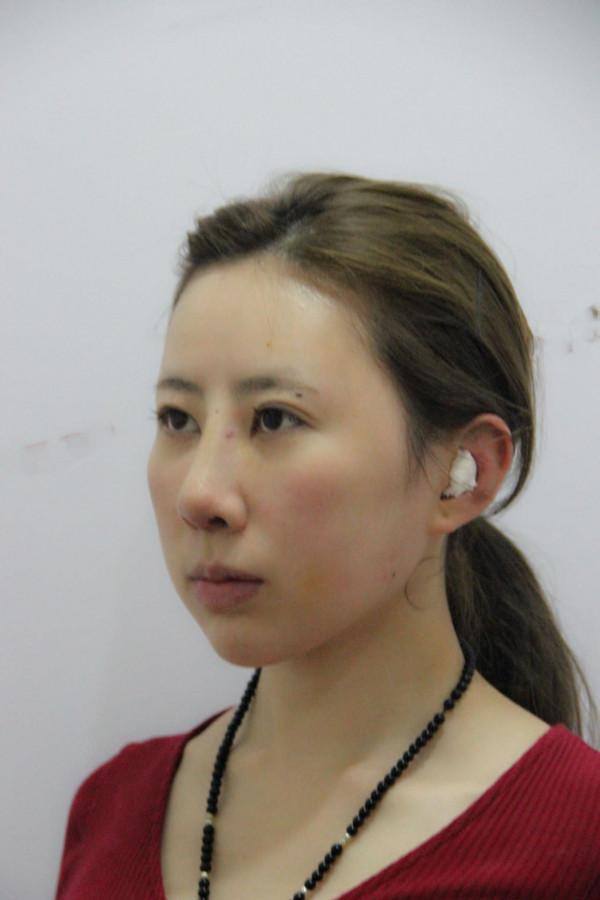 32歲寶媽自體脂肪填充50天，親戚以為我悄悄地換了一張臉