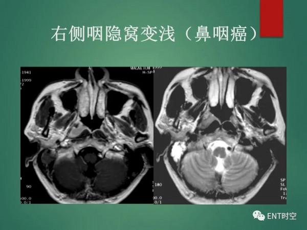 頭頸五官CT斷層解剖圖及常見病影像診斷