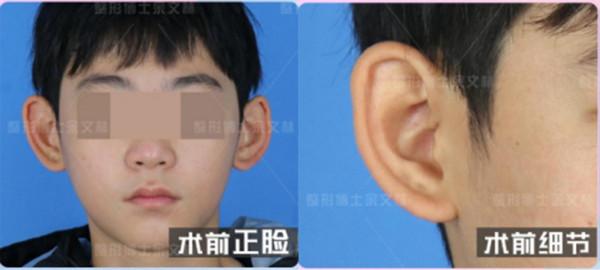 「科普」猿耳是招風耳嗎？兩者有什麼區別？