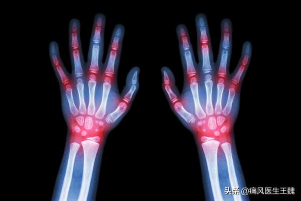 痛風發作，冷敷、熱敷有用嗎？這才是正確做法