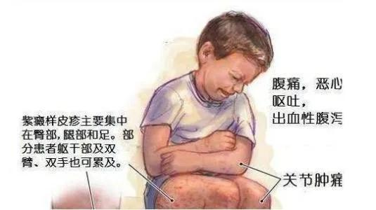 二川椒梅湯治療腹型過敏性紫癜
