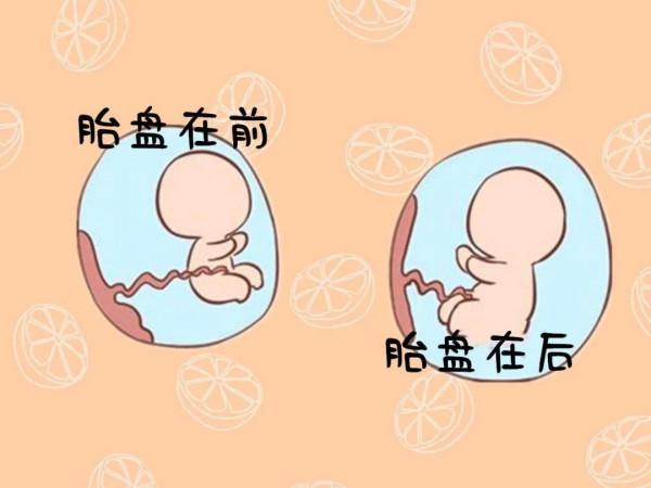 胎盤長在哪裡好？剖腹產後腰痛是打麻醉惹的禍？