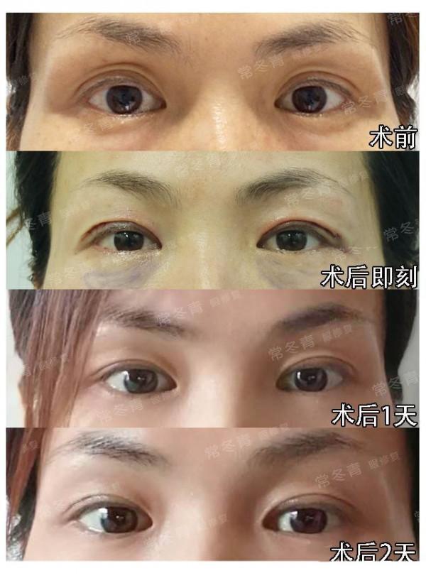 雙眼皮修復 | 常見的3種需要修復情況:寬假深、上瞼凹陷,不對稱 雙眼皮修復 | 常見的3種需要修復情況:寬假深、上瞼凹陷,不對稱