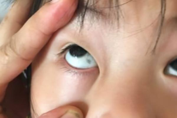 孩子眼白有“黑點”，需要治療嗎？