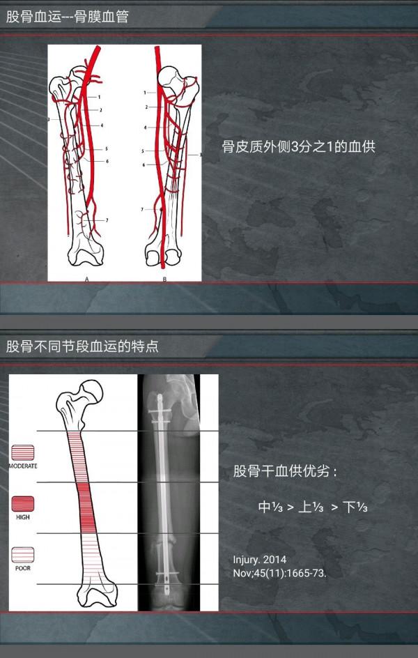 交鎖髓內針治療股骨幹骨折