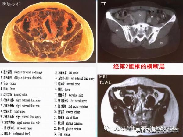 CT斷層解剖圖譜最全總結「推薦收藏」 CT斷層解剖圖譜最全總結「推薦收藏」