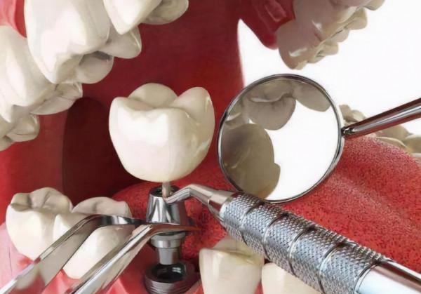 缺牙的朋友？是選擇烤瓷牙還是種植牙？補牙後的怎樣日常護理