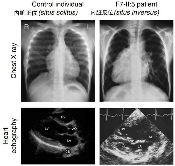 心臟為什麼長在左邊？與這個消失的器官密切相關