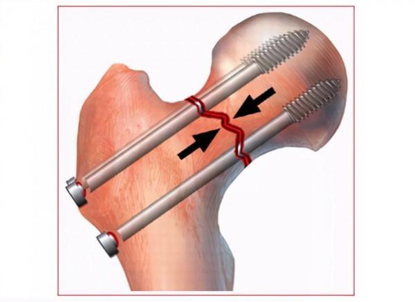 老人股骨頸骨折，關節置換，還是螺釘固定？看看醫生怎說