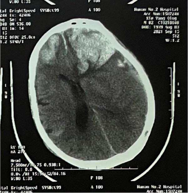 “神藥”阿司匹林真的可以放心吃？