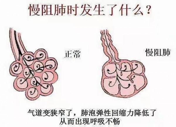 慢阻肺&OpenCurlyDoubleQuote;一動就喘&rdquo;為什麼？怎麼辦？您需要規範治療了
