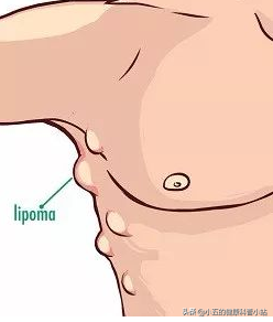 什麼是脂肪瘤，它會癌變嗎，我們應該怎麼正確治療脂肪瘤