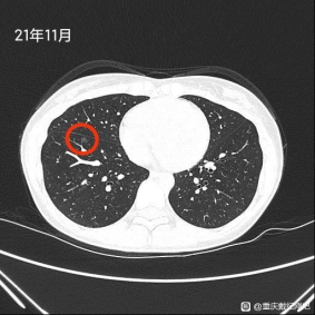 &OpenCurlyDoubleQuote;六年的感情因結節而退縮&rdquo;同行患磨玻璃肺癌心酸求助
