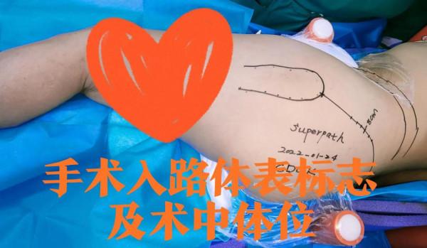 老年股骨頭壞死系列之人工全髖關節置換術&mdash;&mdash;最新微創手術入路