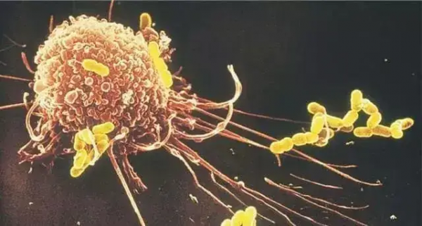 同為癌，原位癌、微浸潤癌、浸潤癌有何區別？