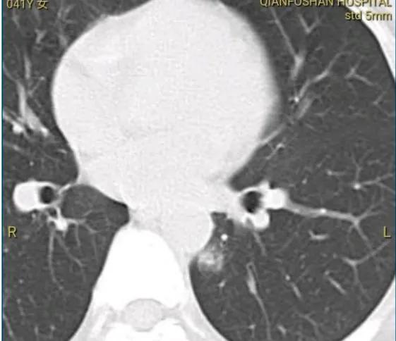 磨玻璃肺結節消融是比手術更好的選擇嗎？患者消融後反而更焦慮了
