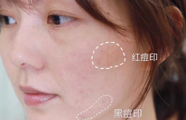 怎樣祛痘和痘印？教你四個小妙招，簡單又實用