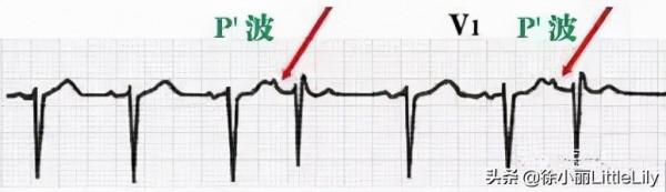 這樣教你看心電圖,沒有理由看不懂 這樣教你看心電圖,沒有理由看不懂