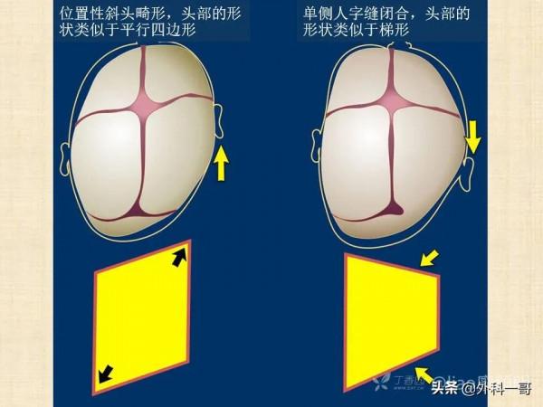 小兒顱縫早閉的診斷治療