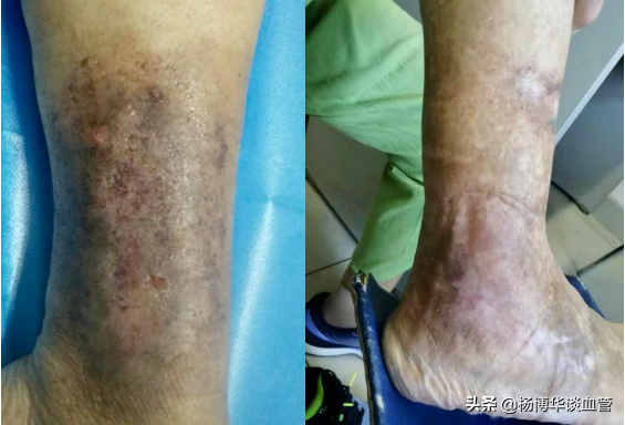 中醫內外合治法預防臁瘡再復發