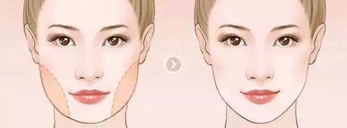 盲目追求瓜子臉,將自己整成這樣,血淋淋的教訓 盲目追求瓜子臉,將自己整成這樣,血淋淋的教訓