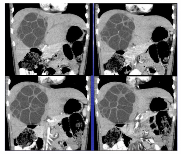 蟲子在肝上&OpenCurlyDoubleQuote;築窩&rdquo;，到底是何病？