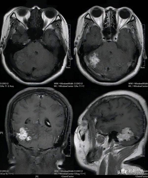 倫琴讀片會預告｜10月28日週四16:00陳向榮教授腦部影像病例讀片