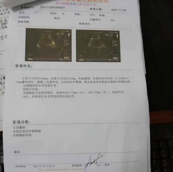 張某,男,50歲,慢性腎衰竭CKD5期(尿毒症期) 張某,男,50歲,慢性腎衰竭CKD5期(尿毒症期)