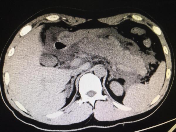 又是熟人惹的禍,急性出血性胰腺炎 又是熟人惹的禍,急性出血性胰腺炎