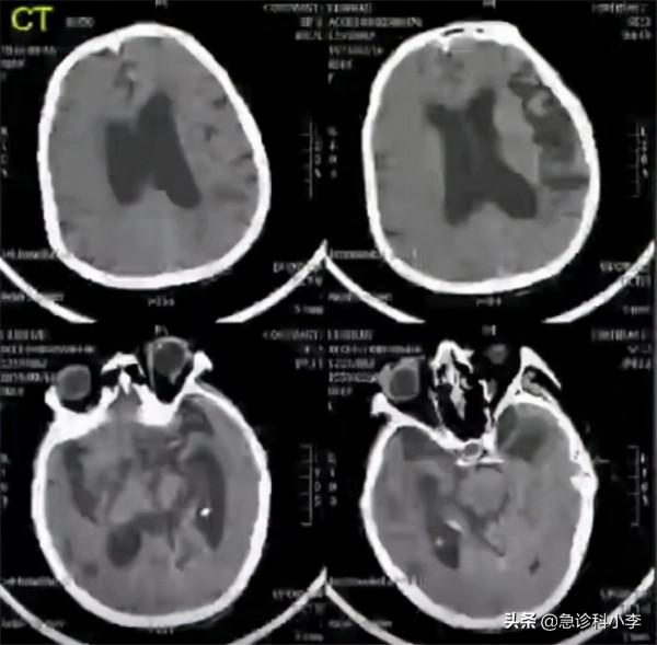 腦梗來臨，睡覺先知？提醒：睡覺出現3個異常，或是腦梗“預警”