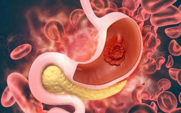 教你如何看胃鏡報告，提醒：報告若出現這3個詞，請提高警惕