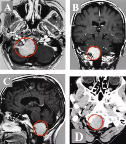 走路乏力、脖子痛，被&OpenCurlyDoubleQuote;頸椎病&rdquo;耽誤的枕骨大孔腦膜瘤怎麼辦？