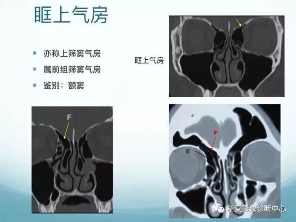 頭頸五官CT斷層解剖圖及常見病影像診斷