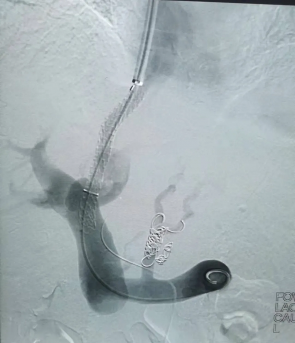 我院胸外科消化介入治療組董劍群團隊成功獨立完成我市首例TIPSS手術【技術新突破】 我院胸外科消化介入治療組董劍群團隊成功獨立完成我市首例TIPSS手術【技術新突破】