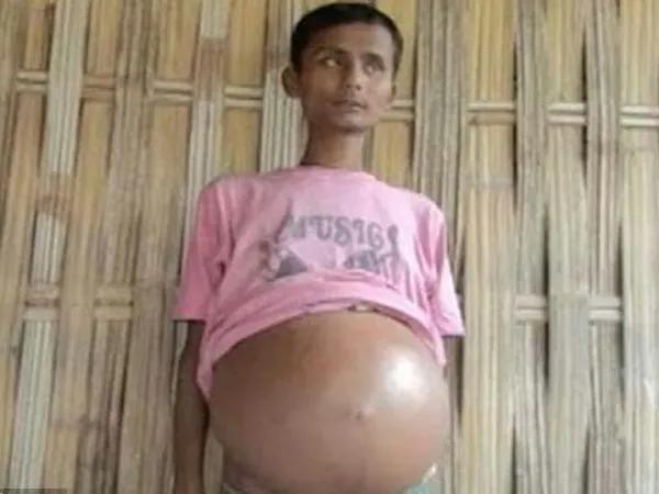 2012年男孩肚子越漲越大，每天只能睡1小時，後來怎麼樣了？