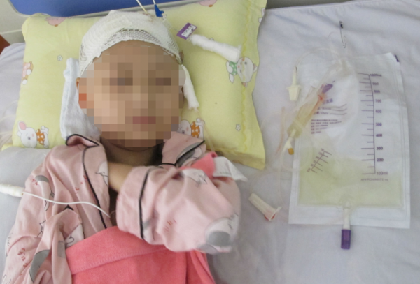 顱內生殖細胞瘤切除術後腦積水仍反覆,意識模糊,左側肢體偏癱 顱內生殖細胞瘤切除術後腦積水仍反覆,意識模糊,左側肢體偏癱